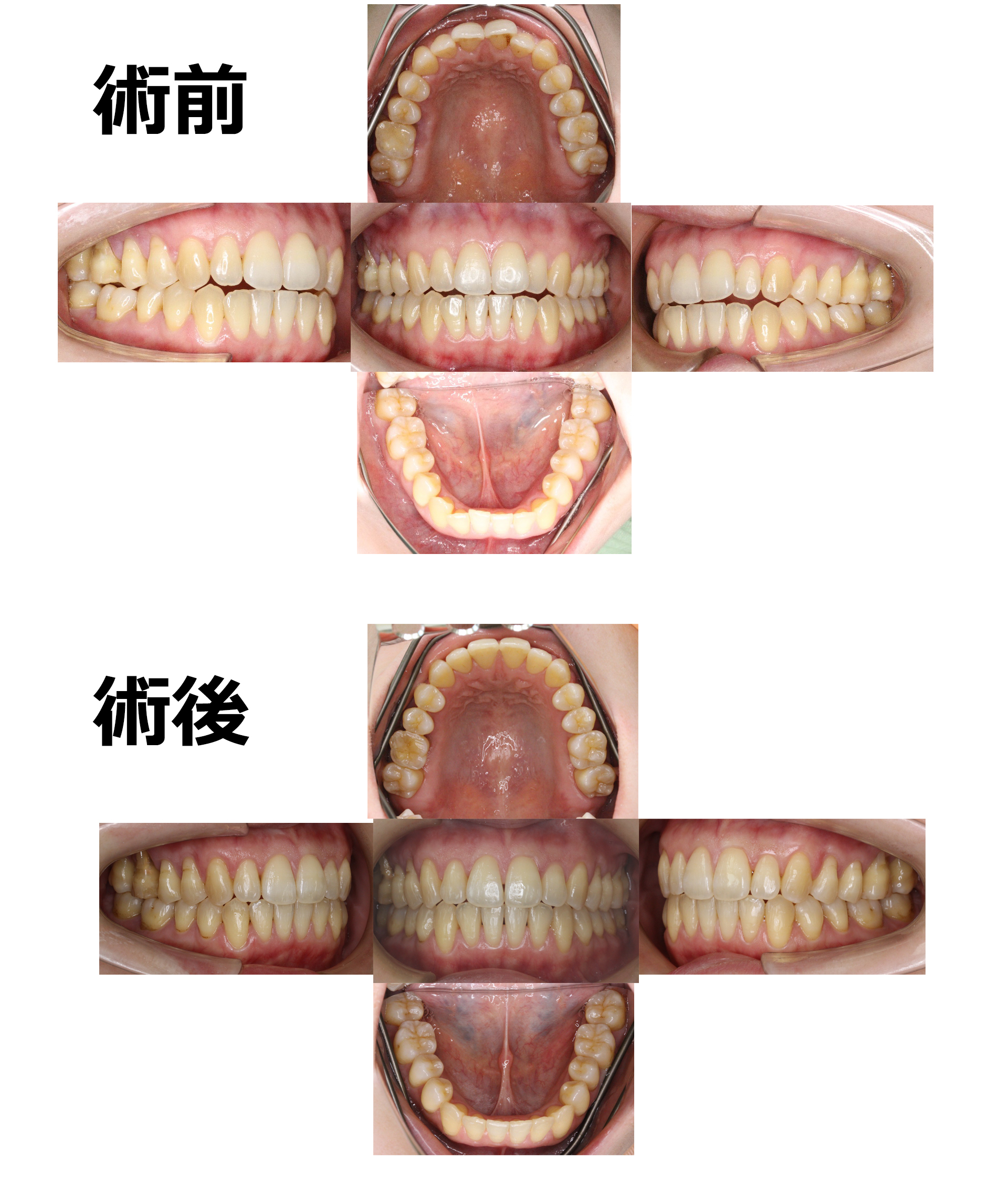 前歯部軽度開咬の症例 | 八王子市の矯正歯科|健にこにこ歯科・矯正歯科